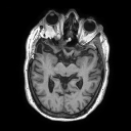 MRI scan showing soft tissue