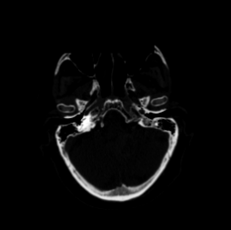 Worst case CT