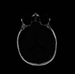Input CT scan